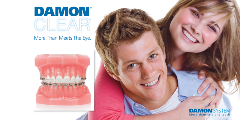 Damon Orthodontic System used at PERFECT SMILE Dental Clinic