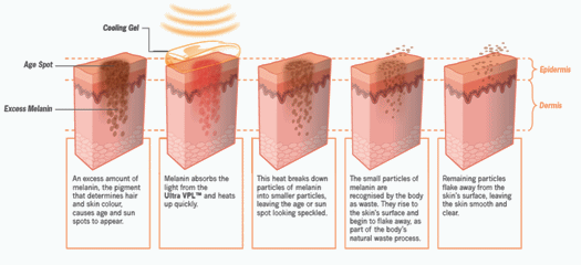 CO2RE LASER for Sun and Age Spots | PERFECT FACE | Facial LASER ...